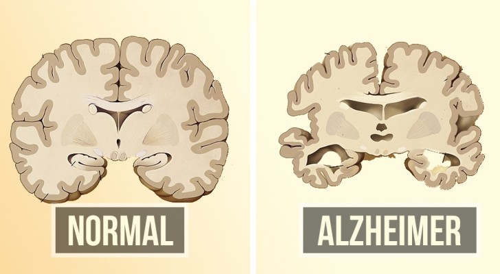Vorbeugen von Alzheimer kann einfacher sein als Sie denken: Hier sind zwei Dinge, die Sie tun können