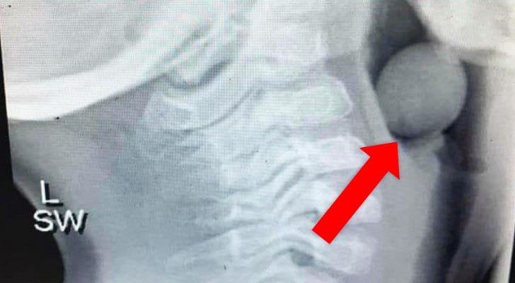 Den här röntgenbilden visar hur en druva som inte har delats kan fastna i luftvägarna på ett barn
