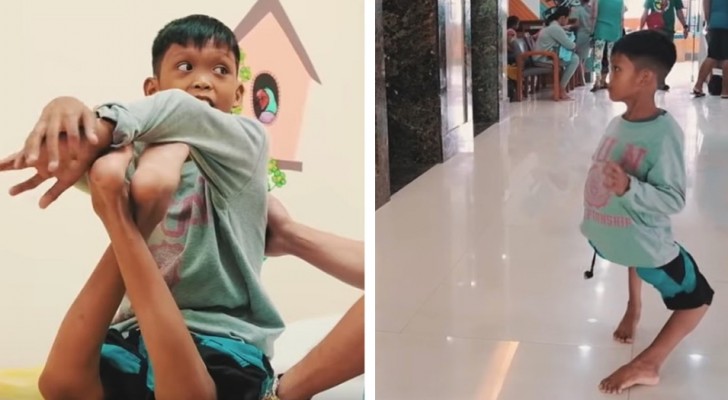He is 11 years old and his knees are bent backward --- but an operation has changed his life and way of walking!