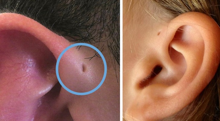 Warum haben manche Leute kleine Löcher in ihren Ohren?