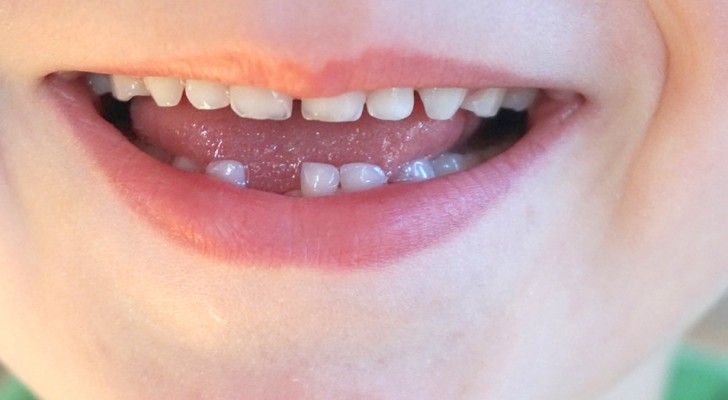 Conservare i denti da latte per utilizzare le cellule staminali: quanto è utile farlo?