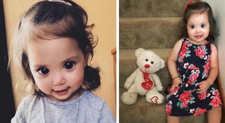 Questa bambina ha una malformazione genetica: i suoi occhi enormi hanno conquistato migliaia di persone