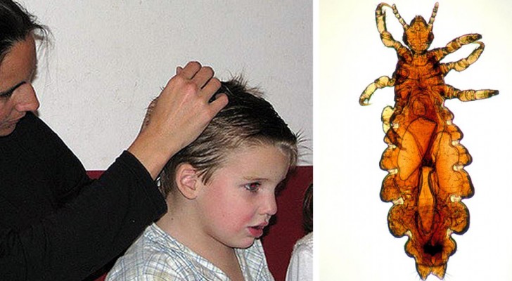 Here is an economic, natural, and homemade remedy to get rid of head lice once and for all