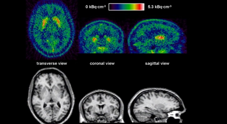Neuroscientists reveal that absentmindedness might actually be a sign that our brain is functioning properly