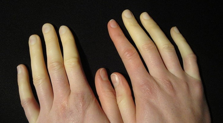 Mani e piedi freddi, che cambiano colore: la sindrome di Raynaud è molto diffusa, ma pochi la riconoscono