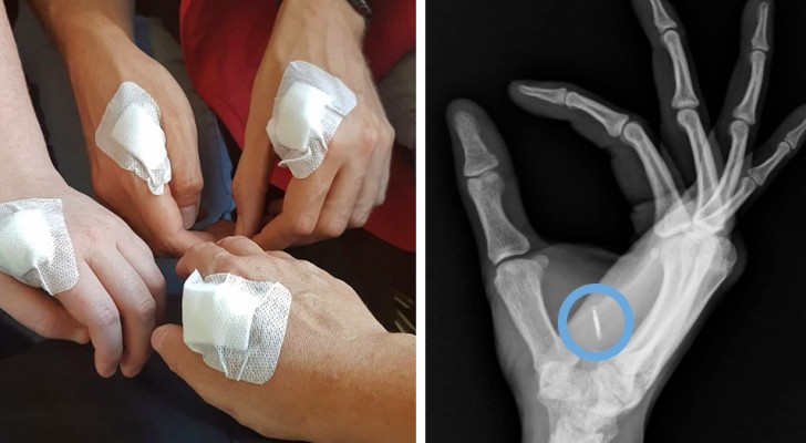 Immer mehr Menschen in Schweden bekommen einen Chip in die Hände implantiert: Dafür ist er da.