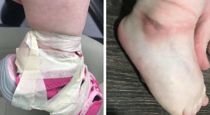 Eine Mutter holt ihre Tochter aus dem Kindergarten ab und entdeckt, dass sie ihren Schuh mit Klebeband befestigt hat 