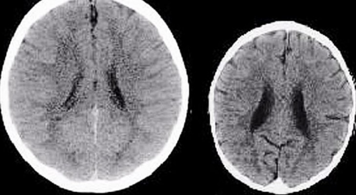 The comparison between the brains of two 3-year-old children makes us understand why it is important to surround children with love