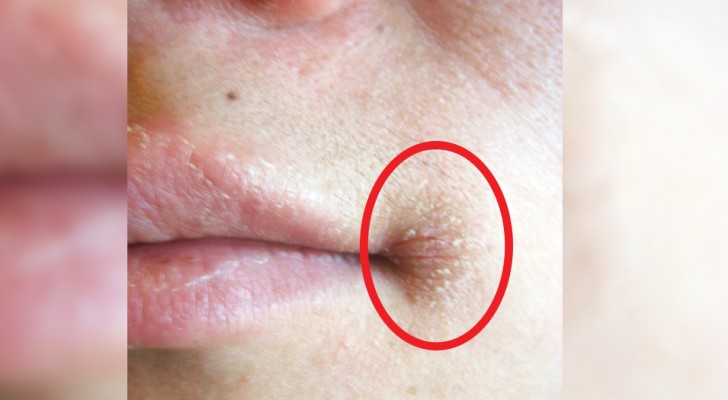 Estomatitis en los ángulos de la boca: porque viene y cual es el remedio más eficaz para curarla