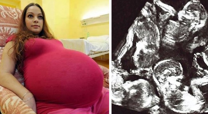 Een vrouw wordt bijgestaan door 40 artsen tijdens haar recordbevalling van een zeer lieve vijfling