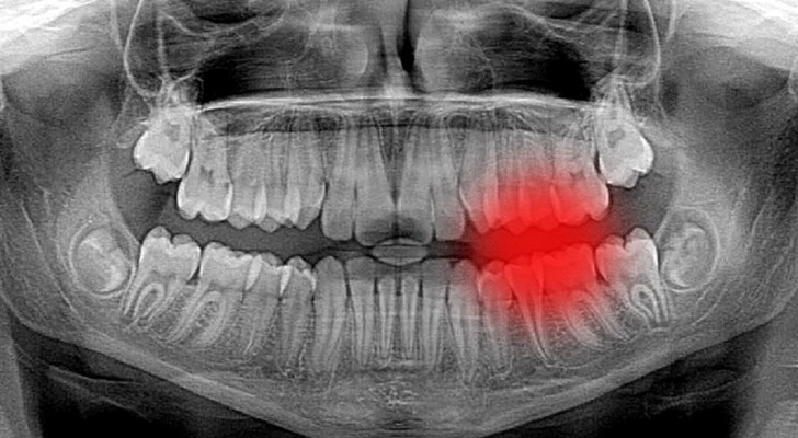 Entdeckung einer neuen Substanz, die die Kariesbehandlung revolutionieren kann: Zähne regenerieren sich selbst