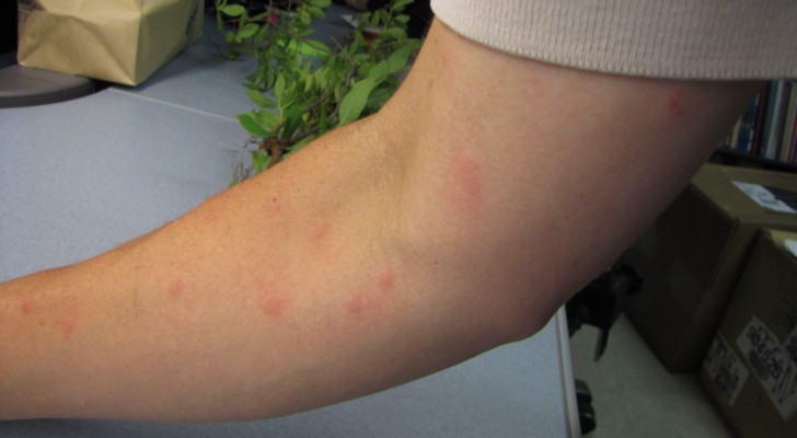 Why do mosquitoes bite you more than anyone else? Here are seven reasons why you are being targeted