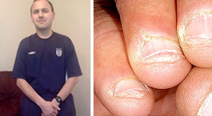 Nail biting can be very dangerous and the sad story of this man shows us why