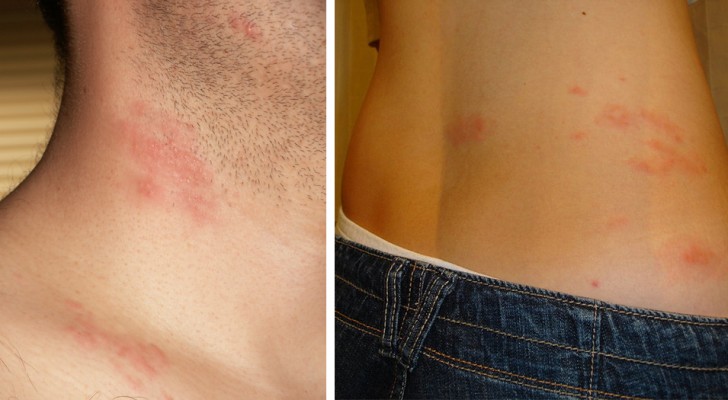 Herpes Zoster aka St. Anthony's fire is activated by stress. Here are the causes and symptoms of this painful skin rash.