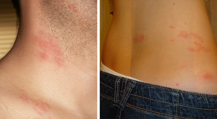 Herpes, der durch Stress aktiviert wird: Ursachen und Symptome dieses schmerzhaften Erythems