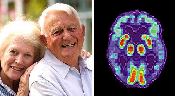 Med dessa enkla övningar kan vi hålla hjärnan i form och hindra utvecklingen av Alzheimers