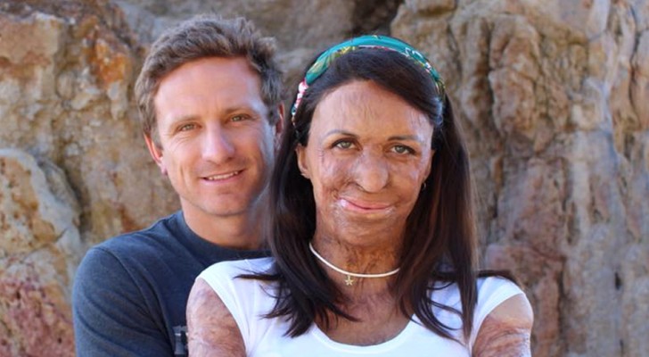 A grass fire disfigured her face and body, but her husband has shown her that love is not based only on physical appearance