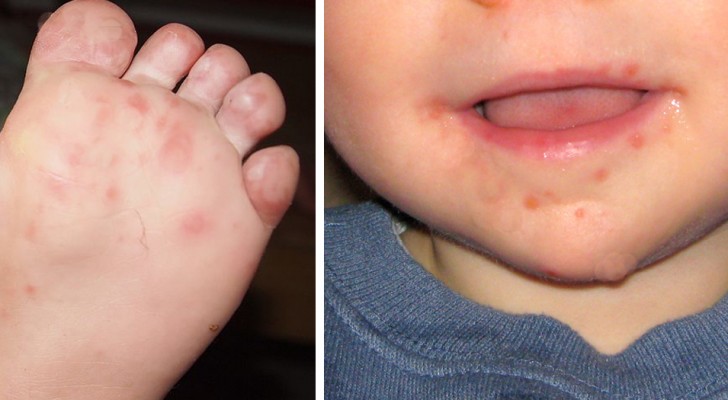 Mano-piede-bocca: la fastidiosa patologia che può colpire i bambini e si combatte con l'igiene