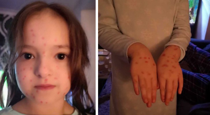 A 6-year-old girl covers herself with chickenpox like dots with a red ink permanent marker to avoid going to school