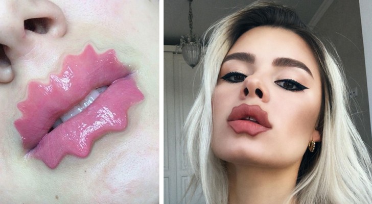 The latest crazy fashion trend in plastic surgery is to have lips like those of cartoon villains