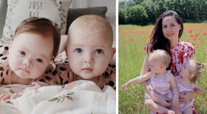 A woman gave birth to a very special pair of twin girls and one of them has Down Syndrome