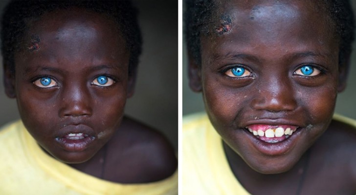 Abushe, the blue-eyed Ethiopian child: he is 8 years old and suffers from a rare syndrome that made him 