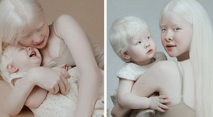 Elles naissent à 12 ans d'intervalle et sont toutes deux albinos : la curieuse histoire de deux sœurs vraiment uniques