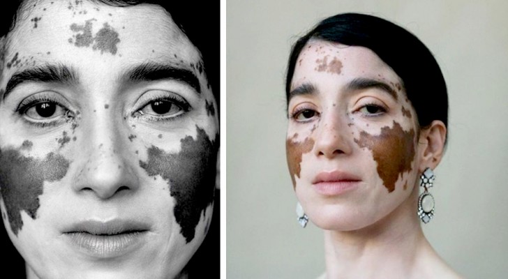 Une photographe avec le vitiligo réalise des clichés où elle illustre cette condition dans toute sa poésie