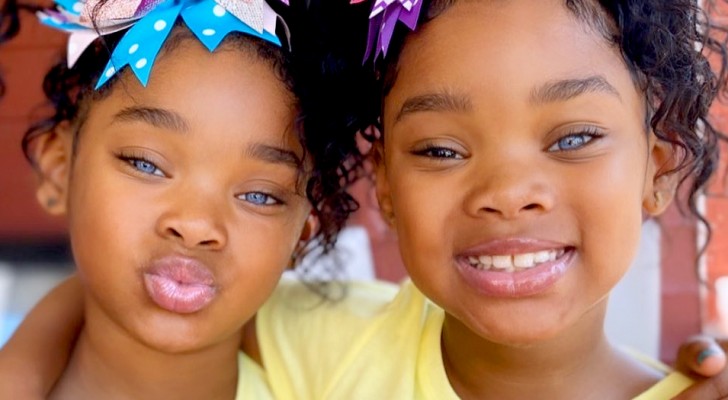These twins have become celebrities thanks to the unusual genetics of their startling eyes