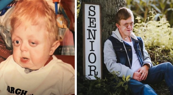 Disseram que ele não teria passado dos 18 meses, mas este menino deficiente fez 18 anos e se formou