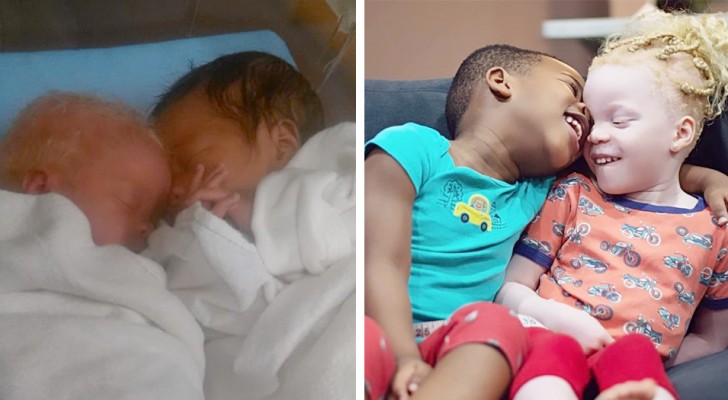 Eine Frau bringt Zwillinge mit unterschiedlicher Hautfarbe zur Welt: ein seltenes Ereignis, das jeden Unterschied willkommen heißt
