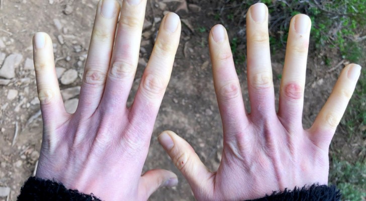 If your fingers start to turn pale when cold, you may have Raynaud's syndrome