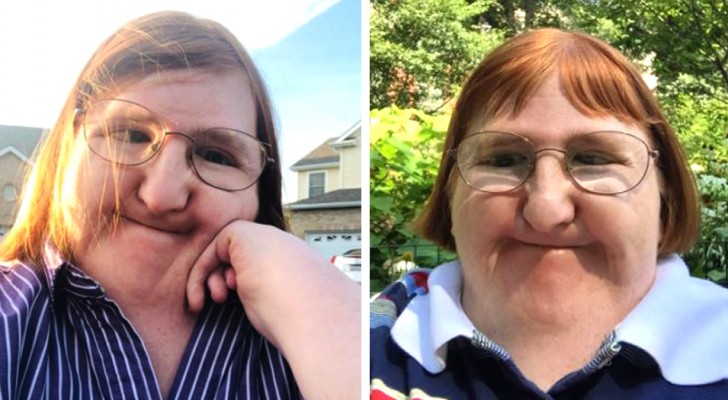 Ze pestten haar op internet vanwege haar handicap: ze reageert door een jaar lang selfies te posten