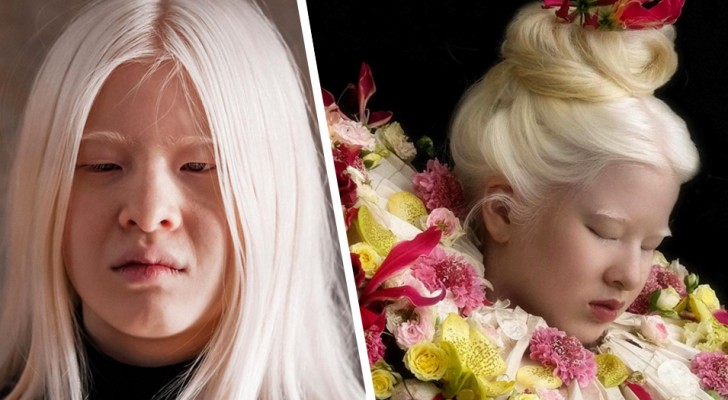 This albino girl was abandoned by her parents because of her looks, but today she is a model for Vogue