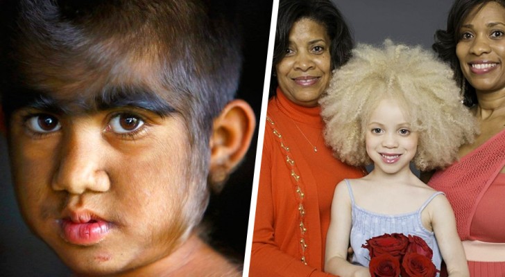 11 niños nacidos con características muy especiales y fuera de lo común