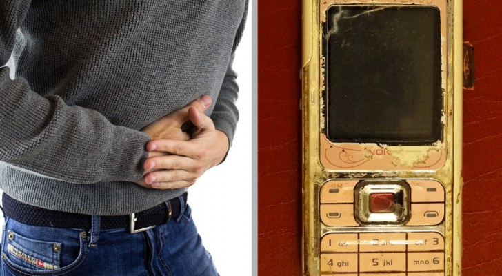 Im Magen eines Mannes wird ein Mobiltelefon gefunden, das er 6 Monate zuvor verschluckt hatte