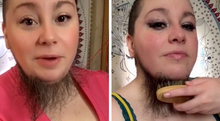 Sick of shaving, this young woman now lets the hair under her chin grow freely