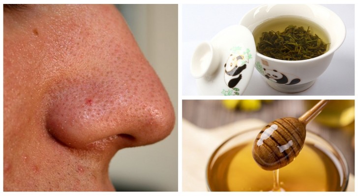 Brufoli e punti neri: prova questi trattamenti naturali da preparare in casa contro l'acne