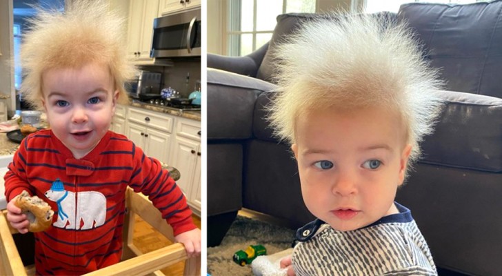 Este bebê tem a síndrome do cabelo despenteado: "achávamos que ele estava com cabelo encaracolado!"