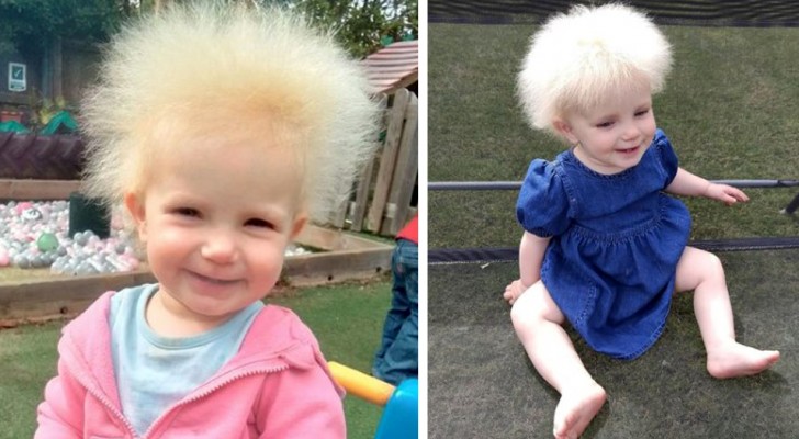 This girl has uncombable hair syndrome (UHS): "up to the age of 12 months her hair was normal, but then it took on a life of its own"