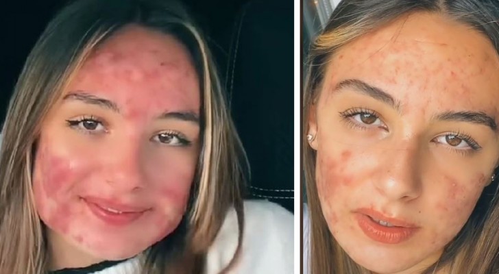 They make fun of her because she suffers from acne: teenager tells her story on social media to challenge the bullies and trolls