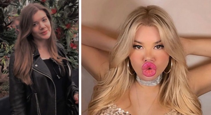 Familjen gillar inte hennes nya utseende: "Jag älskar mina enorma läppar, nu ser jag ut som Barbie"