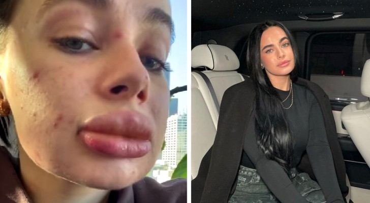 Woman undergoes a free beauty treatment to fill her lips: "It was a disaster" (+ VIDEO)