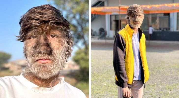 En ung man lider av "varulvssyndromet" och har hela ansiktet täckt av hår