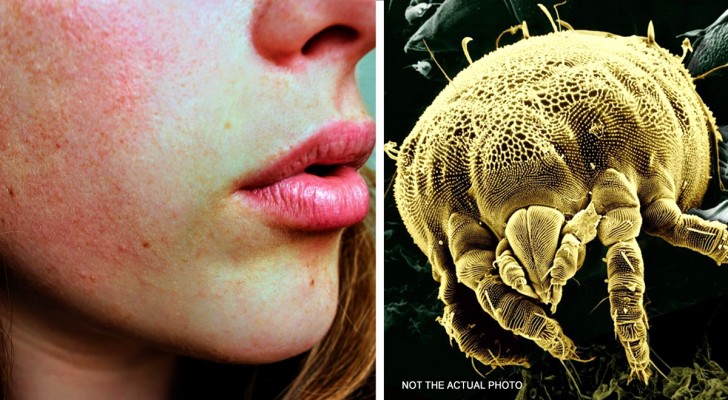 Wusstest du, dass auf deinem Gesicht diese Milben leben? Ein Dermatologe erklärt, was sie sind und wann man eingreifen muss