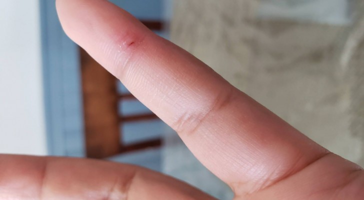 Het onfeilbare huismiddeltje om gemakkelijk splinters te verwijderen