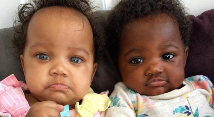 De är tvillingar, men föddes med två helt olika hudfärger