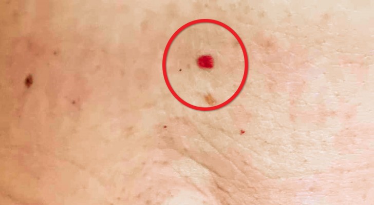 Ze verschijnen van de ene op de andere dag op het lichaam: wat betekenen die rode puntjes?