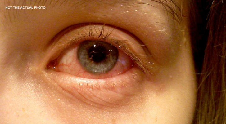 En kvinna förlorade synen på ett av sina ögon på grund av ett banalt misstag som skulle kunna hända alla
