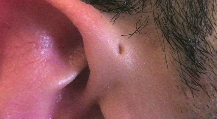 Alcune persone hanno un piccolo buco vicino alle orecchie: perché ce l'hanno?